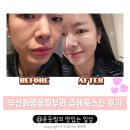 부산화명동피부과 쥬베룩스킨 내돈내산 모공케어 디테일 후기 (통증/다운타임/붓기)