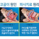 코골이 소리 원인 심할때 줄이는법 멈추는법 간단 정리 이미지