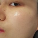 [3차] 압구정로데오역피부과 오타모반 레이저 &amp; 기미잡티레이저(루비레이저) 1~10일차 후기