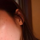 노비뇨기과의원 | 압구정 루나의원 루비레이저 300방 후기 잡티제거 당일~6일차 잡티제거 내돈내산후기