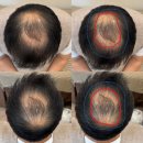 센트모텔 | 내돈내산 머리 문신(SMP) 시술 전후 비교 (feat. 태전동 디앤뷰)