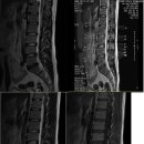 허리통증 MRI 촬영 보고 판독부탁드립니다. 이미지