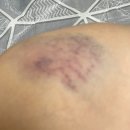 인천정각초등학교 | 구월동 정형외과 추천(새온정형외과), 발목 인대파열 후기