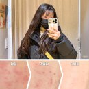 세븐일레븐 의정부가능문화점 | 의정부 편평사마귀 제거치료 후기 일주일 얼굴 상태 기록해봄!