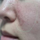 근약국 | 애크린겔 좁쌀 사용법, 약국 가격 및 성분 총정리