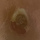 열린문외과의원 | 발바닥사마귀 발바닥사마귀냉동치료 안산발바닥사마귀 안산사마귀제거 [ 열린문외과의원 ]