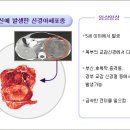 신경아 세포종 이미지