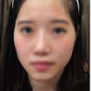 강남미의원 | 강남역미의원 헤어라인제모 깔끔한 후기