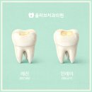 이처럼치과기공소 | 온천장치과, 레진 인레이 차이가 궁금하다면?