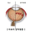 미숙아 망막병증(Retinopathy of Prematurity)눈질환, 소아청소년질환이란? 이미지