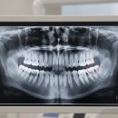 진해치과의원 | 창원 진해구 석동 치과 사랑니 발치 추천 후기