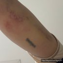 11305-10-26-3 | 담소유 부유방 수술후기3 (회복 1~10일차 리뷰 + 상세 사진 첨부)