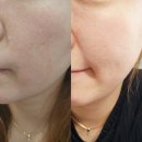 센텀비비의원 | 부산 센텀 피부관리 센텀피부의원 모공 스킨부스터 콜라겐컨택터 2차후기 해운대피부관리