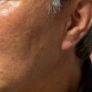흑자헬스장 | 70대 아빠 클라리티 레이저 최종 내돈내산 후기｜흑자 검버섯 편평사마귀 제거 전후 비교