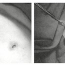 여성형유방 새로운 수술방법: 견인절제법 이미지
