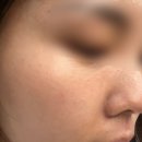 올포원 | [왕십리피부과] 올포원토닝 1회 후기 (CO2, IPL, 토닝, 그린레이저)