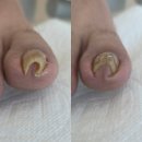[천안 내성발톱 후기] , 발톱 하나 바꿨을 뿐인데, 삶의 질이 달라졌다, “레푸스 천안쌍용점”