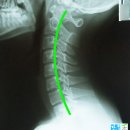 삼풍프라자 | 일자목 거북목은 목디스크로 진행합니다. 교대역 정형외과 목 어깨 통증치료 일자목 거북목 교정과...