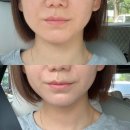 주식회사 다온다옴 | 대구 온다리프팅 피부과 6만줄 1회차 볼살 이중턱 고민해결 후기