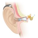 상계독일보청기 이미지