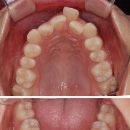 튀어나온 앞니의 발치 교정 / 공주 미소담 치과 교정과 이미지