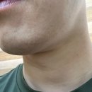 리젠플러스의원 | 용인수지피부과에서 남자수염 2차 레이저제모