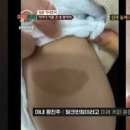 신경섬유종 증상 밀크반점 유전 원인 아기 증상 이미지
