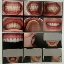 e-클린 치과기공소 | [치과임상] 최소삭제를 위한 라미네이트임상 Chapter 1