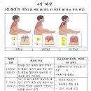 소방공무원, 화상의 정도, 화상의 중증도 분류 ,괴사성, 환자의 증상, 경증, 중증, 1도화상 ,응급처지, 홍반성, 수포성, 도화성, 패혈증으로 이미지