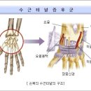 [나우병원 - 팔목 터널 증후군 ] - (Carpal tunnel syndrome) 이미지