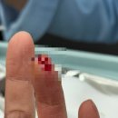 뉴스타트병원 | 고구마 썰다 손가락 썬 후기 : 응급실 손가락 봉합 후기