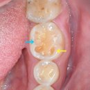 베스트필치과의원 | 본드필(Bondfill) 레진과 차이점 - 부산 양정 치과 본드필 치료!