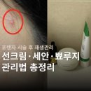 포텐자 시술 후 재생관리 | 모공 시술 후 선크림 세안 뾰루지 딱지 관리 (+안 짜는 법)