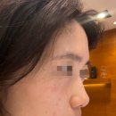 강남역 코필러 일상생활 바로 가능한 비너스코 후기 👨‍⚕️✨