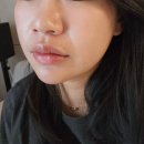 유독이쁨 | 방배동 피부과 줄기세포 스킨부스터 모공, 트러블 완화 후기