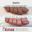 레푸스서면점 | [레푸스 남포점]60대 주부 무좀 발톱 관리 두꺼워진 발톱 관리