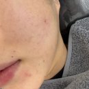 덴탈LED | 달서구 피부관리실 추 온오프에스테틱 진천동 유천동 여드름 압출 &amp; LDM 물방울 리프팅 솔직후기