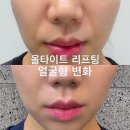 순자 | 얼굴형관리로 받은 23기 순자 리프팅 올타이트 효과 후기