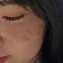 시커먼스 | [리팟레이저]흑자, 색소침착 레이저 끝판왕 만족 후기