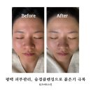 (주)거산코아트 | 평택피부관리 로즈아트스킨 숨결클렌징 붉은기 잡은 후기