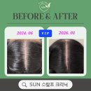 화타의손 | 광교 탈모관리 후기ㅣVIP 고객님 관리스토리 ♥1탄♥