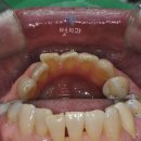 벗치과의원 | 소하동치아교정 앞니만 삐뚤삐뚤한데? 앞니 부분교정, MTA 그게 뭔가요?