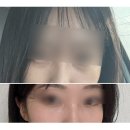 챱챱 | [눈밑지 수술 후기] 2일차부터 두달후기까지 챱챱