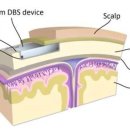 [BCI 뇌-컴퓨터 인터페이스] 세계에서 가장 작은 DBS 장치는 파킨슨병 증상을 반대로 돌려놨다. 영국의 생명 공학 회사인 Bioin 이미지