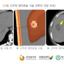 간암의 고주파 치료법이란 이미지