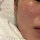 고운세상피부과의원 | 일산고운세상피부과 나비존 모공 시술 실펌엑스 후기