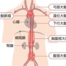 예고없이 일어나는 대동맥류 파열·대동맥 해리 어떤 사람이 위험？ 이미지