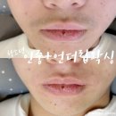 맨드리 | 울산 달동 청소년 남학생 면도하기전! 인중왁싱 후기