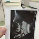 울산대학교 | 울산대학교병원 제왕절개 후기/비용/4박5일입원 후기..🙃