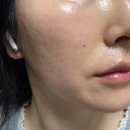 엘라스틴미아사거리역 | 종암동피부과, 포텐자펌핑팁+위코우노 내돈내산 찐 후기(효과,가격,통증)